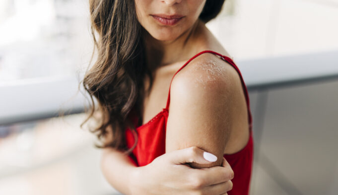 Identify the Signs of Sun Allergy with this Guide