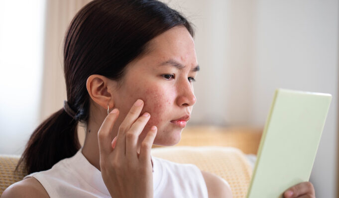 Bubble Skincare Acne Spot Treatment Zapped My Pimples in Two Days