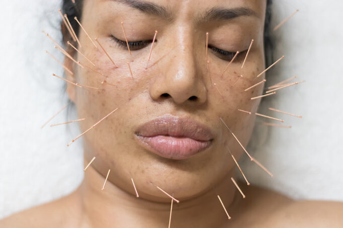 How Cosmetic Acupuncture Offers the Ultimate Glow Up