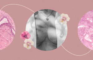 Core Needle Breast Biopsy: What I Wish I Knew